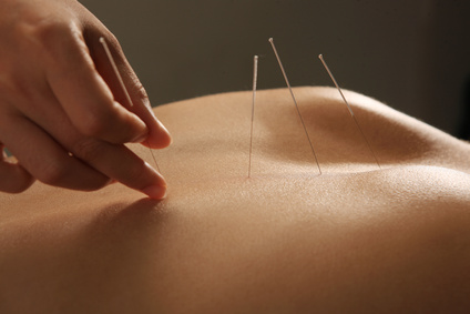 acupuncture