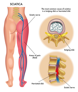 Disc herniation sciatica